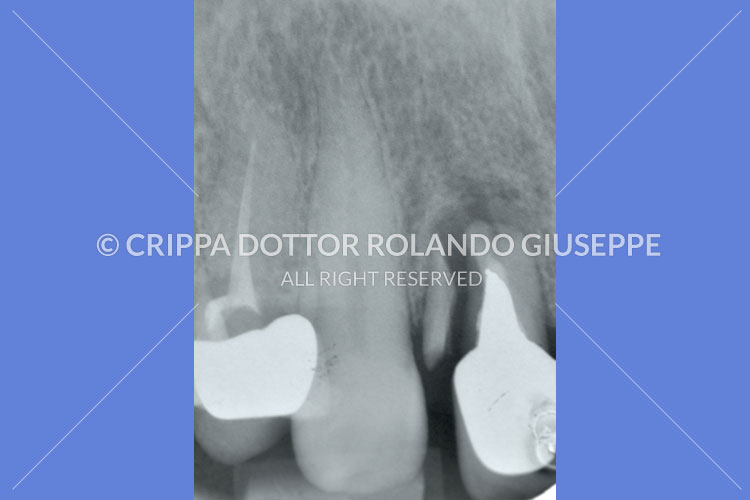 IMPIANTI POST-ESTRATTIVI LASER ERBIO (img 01)