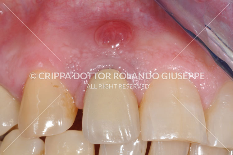 IMPIANTI POST-ESTRATTIVI LASER ERBIO (img 02)