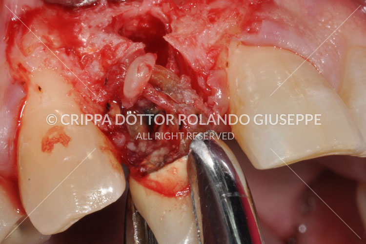 IMPIANTI POST-ESTRATTIVI LASER ERBIO (img 04)