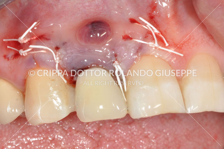 IMPIANTI POST-ESTRATTIVI LASER ERBIO (img 06)