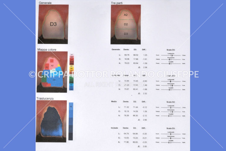 SBIANCAMENTO LASER (img 02)