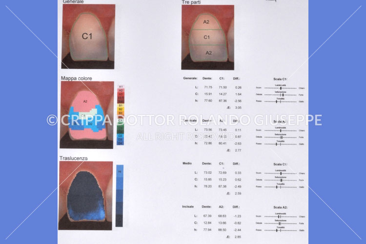 SBIANCAMENTO LASER (img 08)