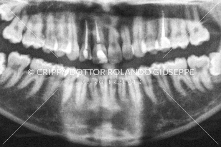 APICECTOMIA E RICOSTRUZIONE MEDIANTE CORONE IN ZIRCONIO DEL GRUPPO FRONTALE DI DESTRA (img 01)