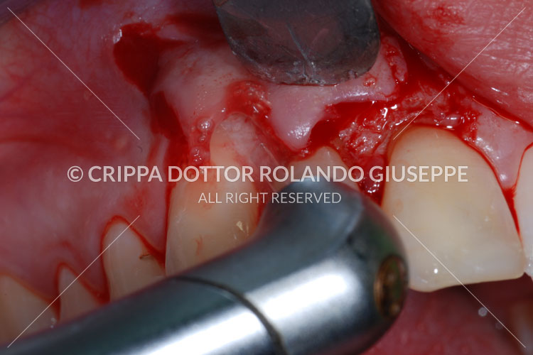 APICECTOMIA E RICOSTRUZIONE MEDIANTE CORONE IN ZIRCONIO DEL GRUPPO FRONTALE DI DESTRA (img 03)