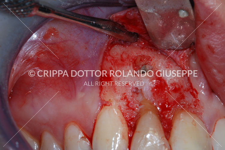 APICECTOMIA E RICOSTRUZIONE MEDIANTE CORONE IN ZIRCONIO DEL GRUPPO FRONTALE DI DESTRA (img 04)