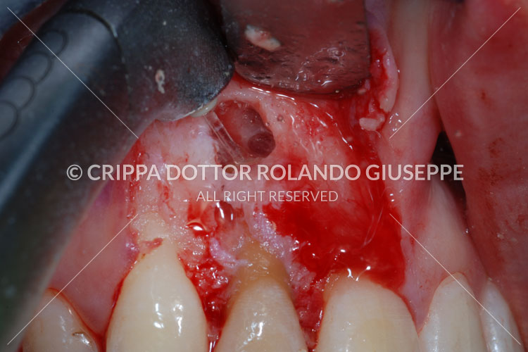 APICECTOMIA E RICOSTRUZIONE MEDIANTE CORONE IN ZIRCONIO DEL GRUPPO FRONTALE DI DESTRA (img 05)