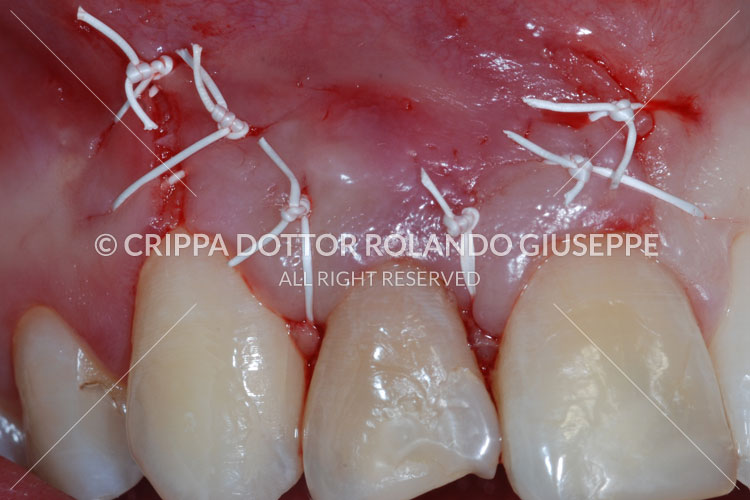 APICECTOMIA E RICOSTRUZIONE MEDIANTE CORONE IN ZIRCONIO DEL GRUPPO FRONTALE DI DESTRA (img 07)