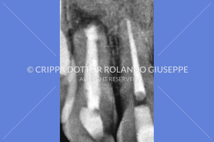 APICECTOMIA E RICOSTRUZIONE MEDIANTE CORONE IN ZIRCONIO DEL GRUPPO FRONTALE DI DESTRA (img 08)