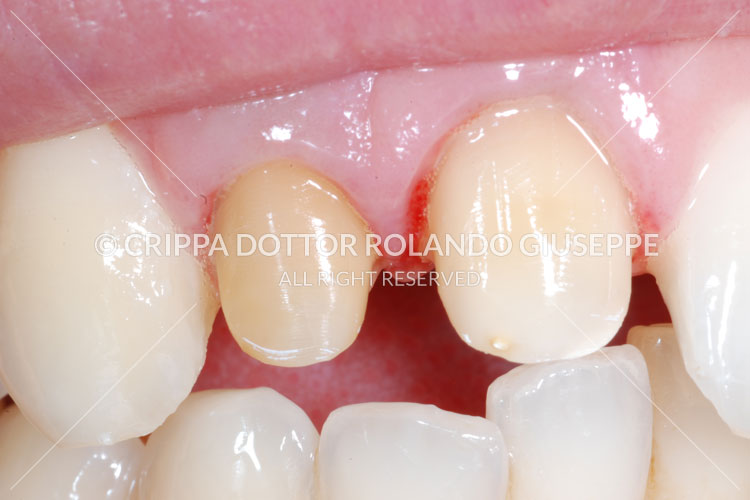 APICECTOMIA E RICOSTRUZIONE MEDIANTE CORONE IN ZIRCONIO DEL GRUPPO FRONTALE DI DESTRA (img 09)